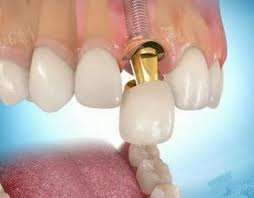 Estetica dental indolora, precios promocionales, adultos y niños, odontologia de categoria, financiacion propia.