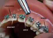 Tipos y marcas de brackets: Ventajas y desvantajas al elegir tratamiento de ortodoncia