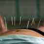 Los principales beneficios de la acupuntura